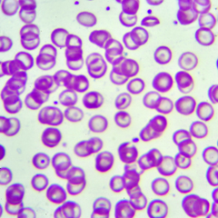 Talassemia