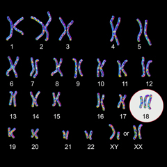 Trisomia 18