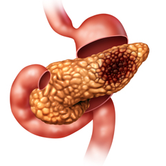 Tumore del pancreas