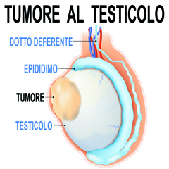 Tumore del testicolo