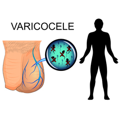 Varicocele